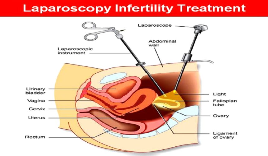 Understanding Laparoscopy: A Comprehensive Guide for Infertility Patients in Chennai