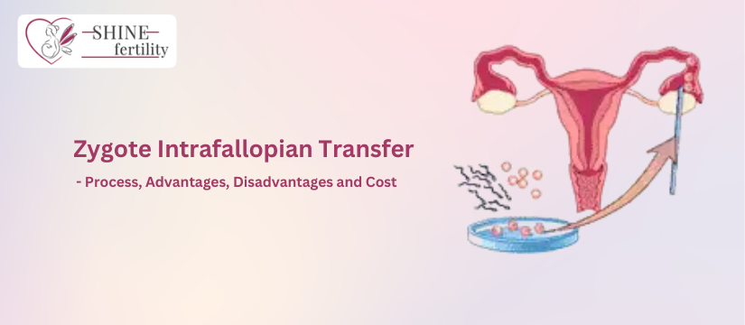 Zygote Intrafallopian Transfer (ZIFT) – Process, Advantages, Disadvantages and Cost